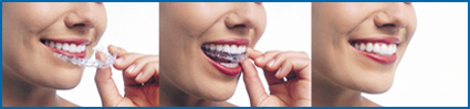 Invisalign